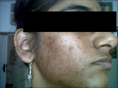 R Singh – Testimonial for Pimple & Acne