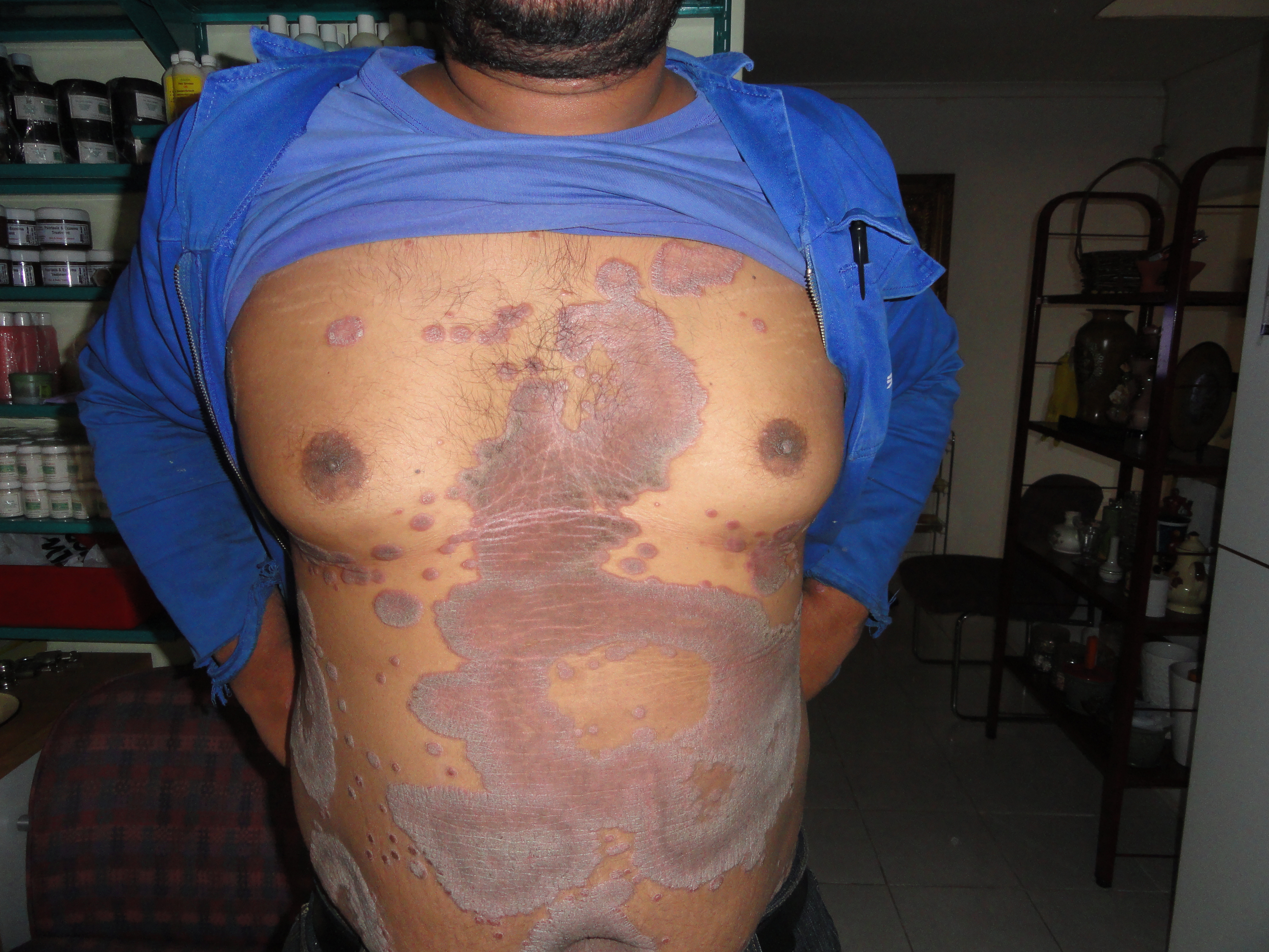 Psoriasis treatment for a Medical Practitioner